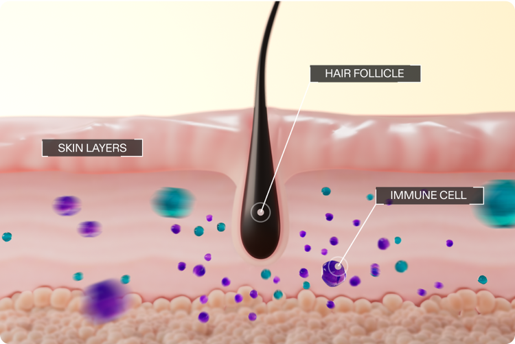 Alopecia areata mechanism of disease. Illustration of immune cells swarming a hair follicle after mistakingly receiving signals to attack it.