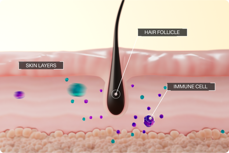 Illustration of a decreased number of attacking immune cells around the hair follicle.