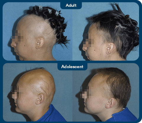 Clinical study photos showing adult and adolescent patients with severe alopecia areata before and after taking LITFULO™ (ritlecitinib)